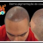 dermo pigmentaçao capilar